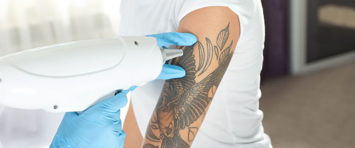 Tattoo Removal Machine